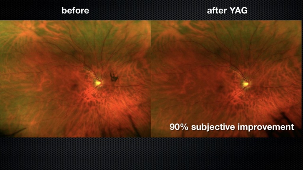 Study finds YAG laser vitreolysis may be option for floaters Squiggly Lines