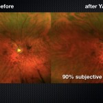 Before-and-after images show the results of YAG vitreolysis for patients with symptomatic floaters. (Images courtesy of Chirag Shah, MD, MPH)